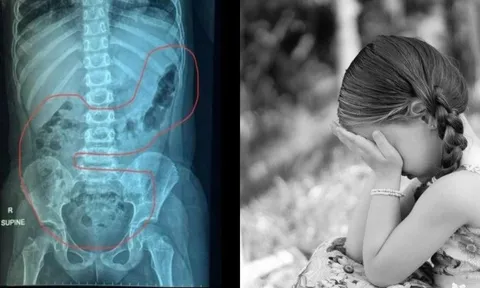 Bé gái 5 tuổi đau bụng dữ dội, phân ứ đọng chèn ép đến phổi: Bác sĩ xem X-quang mà bàng hoàng