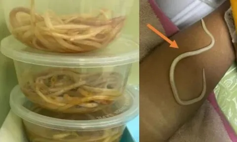 Nôn ra giun, bé 3 tuổi được bác sĩ gắp hàng chục con giun sống ra khỏi bụng: Thói quen sai lầm nhiều phụ huynh chủ quan