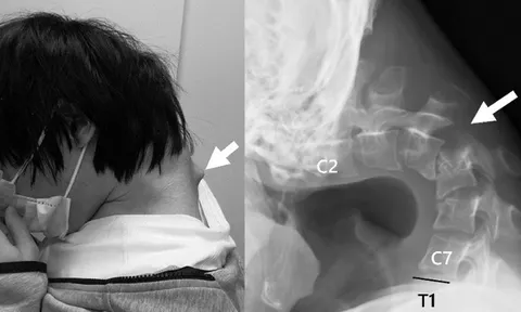 Thanh niên 25 tuổi cúi đầu xem điện thoại đột ngột đau cổ dữ dội, không thể ngẩng đầu, suýt liệt cổ: Cảnh báo giới trẻ