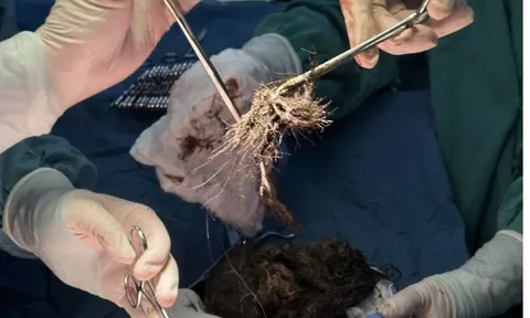 Hãi hùng cảnh tượng bác sĩ lấy ra 2kg tóc trong bụng thiếu nữ 15 tuổi: Cảnh báo về thói quen vô cùng nguy hiểm