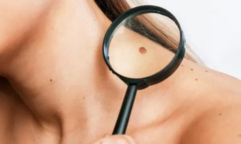 5 vị trí nốt ruồi trên cơ thể có thể biến thành ung thư, ai cũng có nguy cơ cao: Đừng chủ quan, hãy kiểm tra ngay