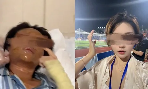 Hot girl livestream mở gói hàng thì phát nổ, mặt biến dạng hoàn toàn: Nghi án trả thù tình cảm, camera an ninh hé lộ tình tiết quan trọng