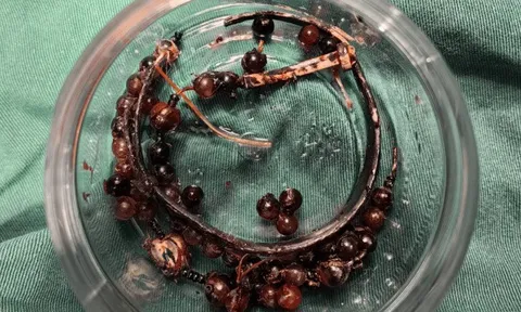 Hãi hùng: Đeo vòng tay suốt 10 năm không tháo, người phụ nữ suýt mất mạng vì vòng 'ăn' sâu vào da thịt