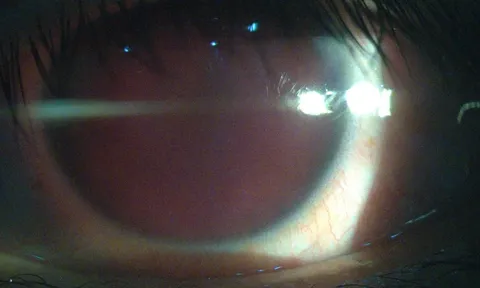 Nam thanh niên bị thủng mắt vì làm một việc quen thuộc mà đàn ông trong nhà thường làm