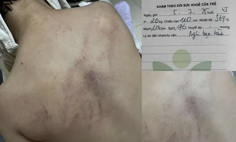 Thông tin mới nhất vụ bé gái 4 tuổi đi học bị bạo hành đến tím lưng vì không chịu ngủ