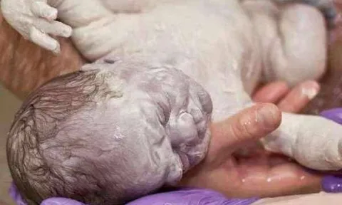 Bố mẹ phát hoảng khi con sơ sinh chào đời người trắng bệch, tưởng bệnh lạ nhưng bác sĩ lại vỗ tay chúc mừng