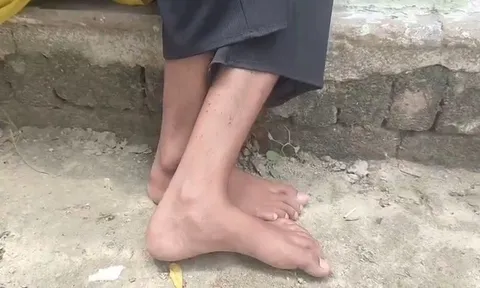 Bé gái lớp 9 bị rắn cắn 9 lần trong 40 ngày: Ám ảnh sợ hãi về con rắn lớn "khủng khiếp"