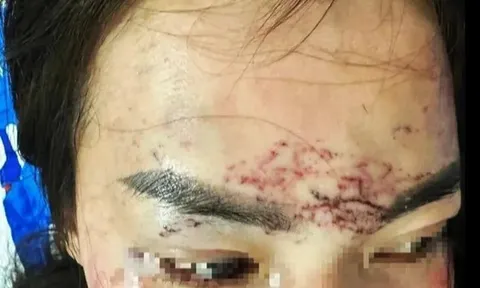 Vụ 2 phụ nữ đánh ghen, đổ axit, xăm mặt người khác ở Cà Mau có diễn biến mới