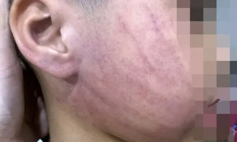 Vụ bé 4 tuổi nghi bị giáo viên mầm non đánh bầm tím mặt ở Hà Nội: Giáo viên phụ trách nói gì?