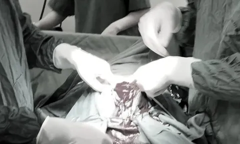 Tự phá thai 33 tuần, thai phụ bị vỡ tử cung 3 lít máu tràn ổ bụng: Tiết lộ điều đặc biệt trong ca mổ xuyên đêm giành sự sống từ tay "tử thần" cho bệnh nhân