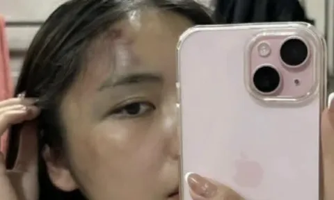 Chồng kéo vợ ra hành lang chung cư, đánh đến thủng màng nhĩ, chấn động não: Do không về sớm nấu cơm khi có bố mẹ chồng?