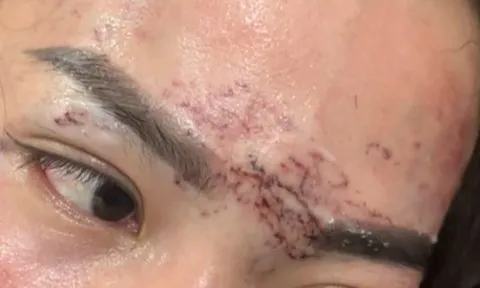 Hai người phụ nữ lĩnh 7 và 8 tháng tù vì dùng kéo cắt tóc lấy máy phun xăm vào trán, mặt người nghi "tình địch"