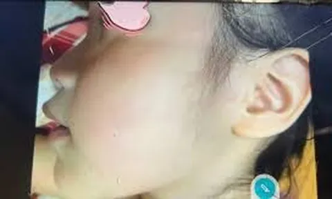 Bé gái bị cô tát ngay ở lớp, phụ huynh bức xúc đăng lên mạng khi phía nhà trường im lặng