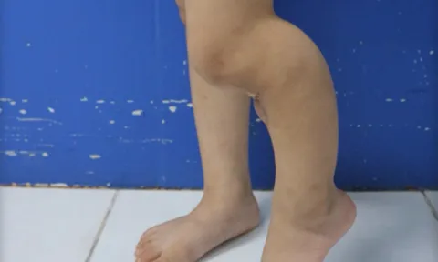 Khoét bột để đắp lá cho con khi đã được bó bột, bố mẹ khiến con gái không thể liền xương