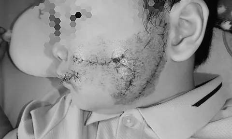 Thương tâm: Đang chơi trong sân nhà, bé trai 5 tuổi bất ngờ bị chó lao vào tấn công cắn rách mặt