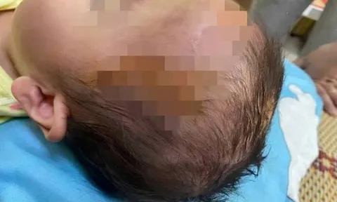 Bé gái 19 tháng tuổi đang chơi ngoài đường bất ngờ bị chó dữ tấn công, thương tích nghiêm trọng vùng mặt, đầu và cổ