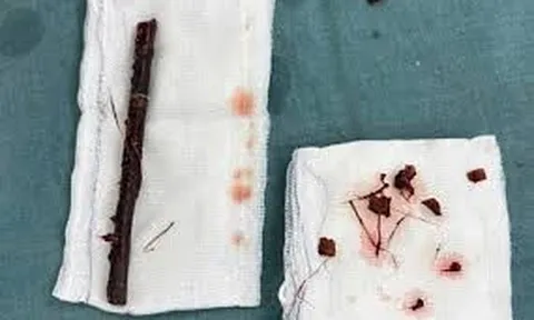 Ho và sốt không dứt, bé gái 3 tuổi khiến bác sĩ sốc nặng khi phát hiện cành cây dài 16cm nằm trong bụng suốt 4 tháng