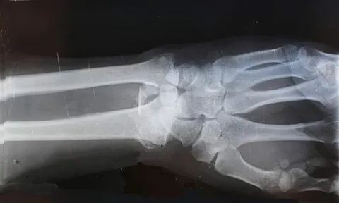 Nối liền xương gãy chỉ trong 3 phút nhờ 'keo siêu dính' Bone-02: Cuộc cách mạng y học khiến bác sĩ cũng không tin vào mắt mình!