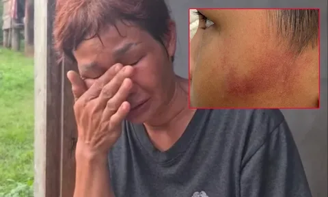 Cô giáo dùng thước sắt đánh tới tấp 14 nhát vào mặt học sinh 7 tuổi chỉ vì ăn một viên kẹo