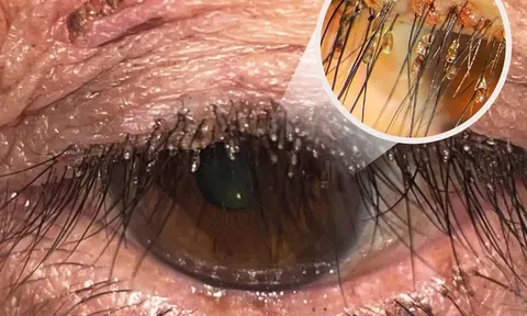 Ngứa, cộm mắt kéo dài, người phụ nữ đi khám mới biết rận mu bám chi chít trên lông mi