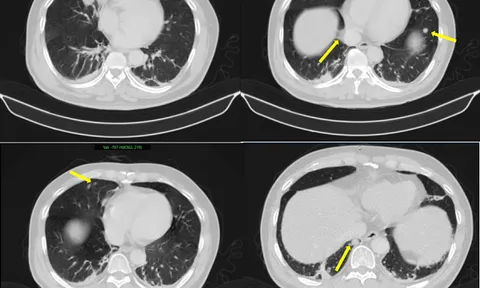 Người đàn ông phát hiện cùng lúc 2 ung thư trong chưa đầy 2 tháng: Trường hợp hiếm