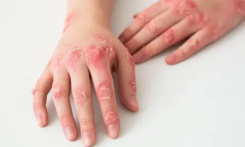 Con nổi nốt đỏ ở lòng bàn tay, bác sĩ nói một câu khiến người mẹ chết lặng
