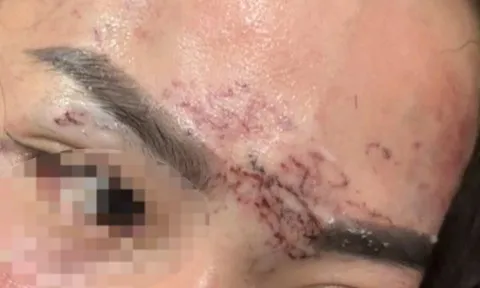 Vụ nghi đánh ghen, người phụ nữ bị xăm lên mặt, cắt tóc ở Cà Mau: Diễn biến nóng