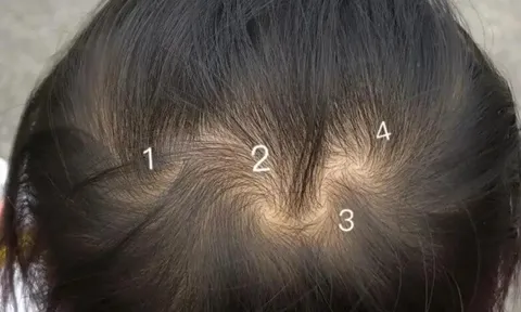 Mẹ phát hiện trên đầu con xuất hiện 7 vòng xoáy kỳ lạ, lo lắng đưa đến viện khám, bác sĩ thốt lên: Thật hiếm gặp!