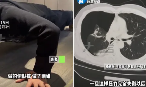 Quyết tâm tập thể dục để giảm cân sau Tết, nam thanh niên bị xẹp phổi