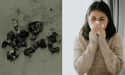 Liên tục ngửi thấy mùi hôi, người phụ nữ giật mình khi phát hiện thứ kỳ lạ này trong mũi