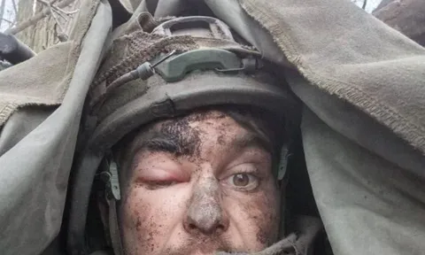 Mặc kệ viên đạn mắc kẹt trong não, người lính Nga vẫn kiên cường chiến đấu suốt cả tuần