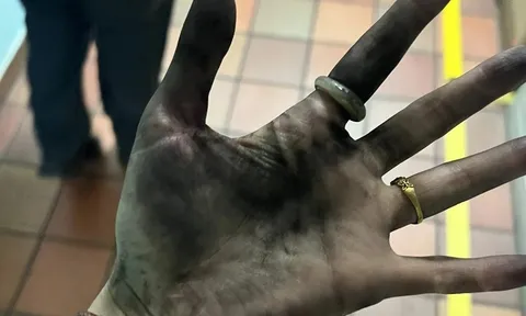 Cục sạc dự phòng bất ngờ phát nổ, người phụ nữ hoảng hồn khi nhìn xuống bàn tay mình