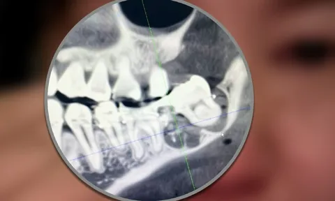 Một cô gái mất mạng vì bị nhổ nhầm răng: Ca phẫu thuật 90 phút không thuốc tê và cái kết xót lòng