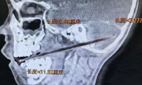 Vừa ăn vừa chạy nhảy, bé trai Trung Quốc bị que kẹo 11cm đâm xuyên từ miệng lên não
