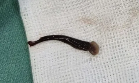 Bé gái chảy máu cam suốt 4 ngày, bác sĩ choáng váng khi phát hiện “thủ phạm” sống trong mũi