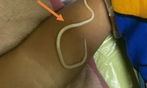 Bé trai 3 tuổi nôn ra hàng trăm con giun sống, bác sĩ cảnh báo thói quen nguy hiểm này