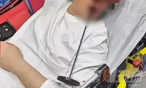 Nam thanh niên say rượu ngã vào thanh sắt, bị đâm xuyên từ miệng lên đầu: Ca phẫu thuật nghẹt thở kéo dài 10 tiếng