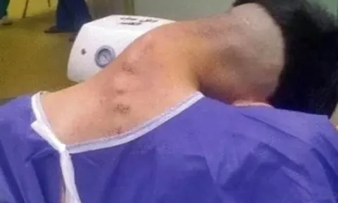 Chàng trai 23 tuổi mắc hội chứng “gục đầu”, cổ cong 90 độ sau nhiều năm nghiện ma túy