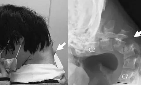 Ngẩng đầu không nổi vì chơi điện thoại quá nhiều, nam thanh niên gặp biến chứng nghiêm trọng