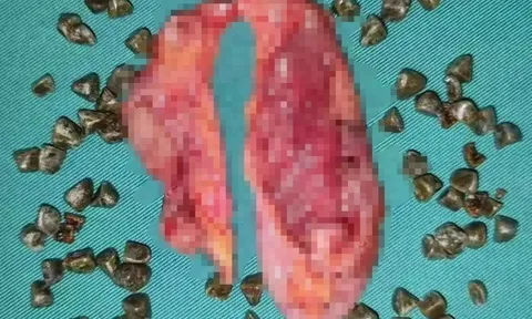 Người phụ nữ phát hiện gần 100 viên sỏi mật vì thói quen sinh hoạt mà nhiều người trẻ dễ mắc phải