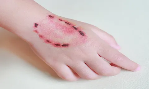 Cắn người như zombie ở Singapore: Nạn nhân bị xé rách tay, phải ghép da để cứu chữa