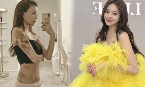 Nữ người mẫu thắng kiện phòng khám sau 4 năm bị hủy hoại sức khỏe, phơi bày mặt tối ngành thẩm mỹ