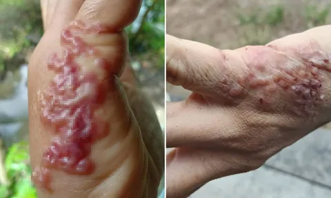 Cô gái ngứa rát cả đêm, chết lặng khi phát hiện giun móc bò dưới da