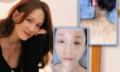 Nữ minh tinh xứ Đài gây sốc với bức ảnh châm cứu kín mặt, dân mạng “rợn tóc gáy”