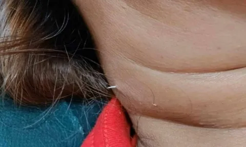 Tưởng viêm họng, đi khám thì bác sĩ tái mặt khi thấy dị vật xuyên ra từ cổ bệnh nhân