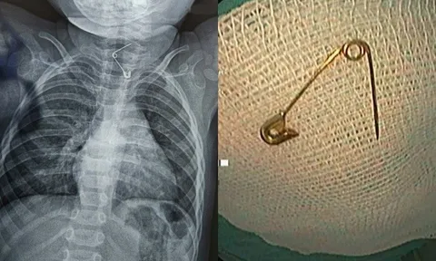 Bé 12 tháng tuổi nhập viện vì bị kim băng ghim thẳng vào thực quản: Bác sĩ cảnh báo 1 sai lầm nhiều cha mẹ mắc phải