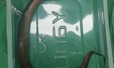 Đau bụng, đi khám, bác sĩ chết lặng khi thấy sinh vật dài 30cm đang ngọ nguậy trong ổ bụng bệnh nhân