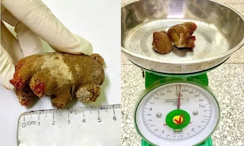 Bác sĩ bàng hoàng khi gắp ra viên sỏi như mảnh san hô nằm trong cơ thể người đàn ông suốt 20 năm