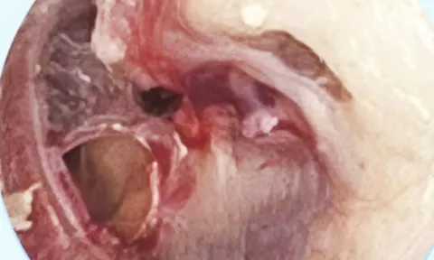 "Báo con" vô tình khiến mẹ thủng màng nhĩ, nhập viện gấp chỉ vì trò chơi quen thuộc của biết bao đứa trẻ