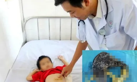 Bé trai 5 tuổi nhập viện vì đau bụng, bác sĩ sững sờ khi phát hiện dị vật này